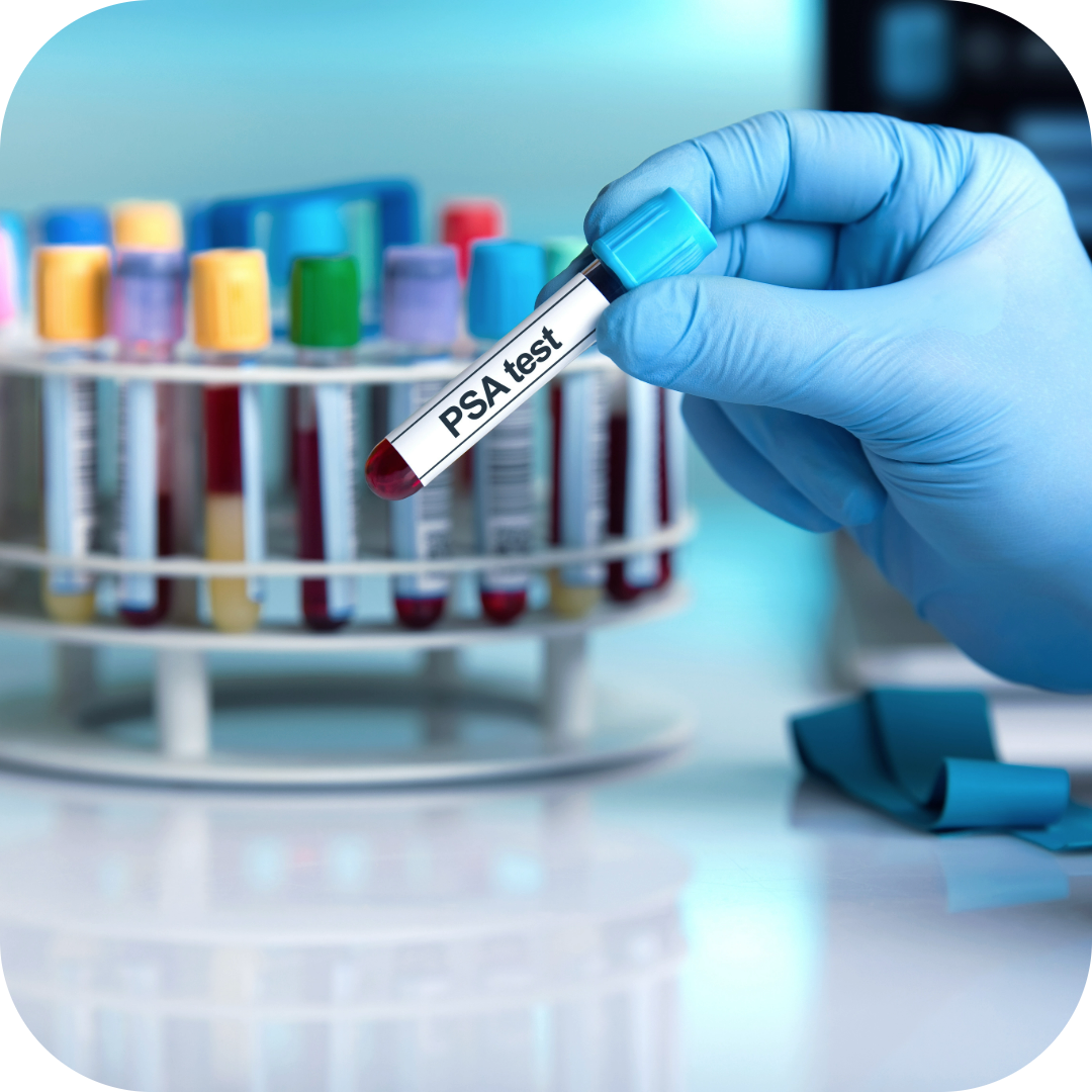 New Research Highlights Prostate Cancer Inequalities and Builds on SPCR Insights